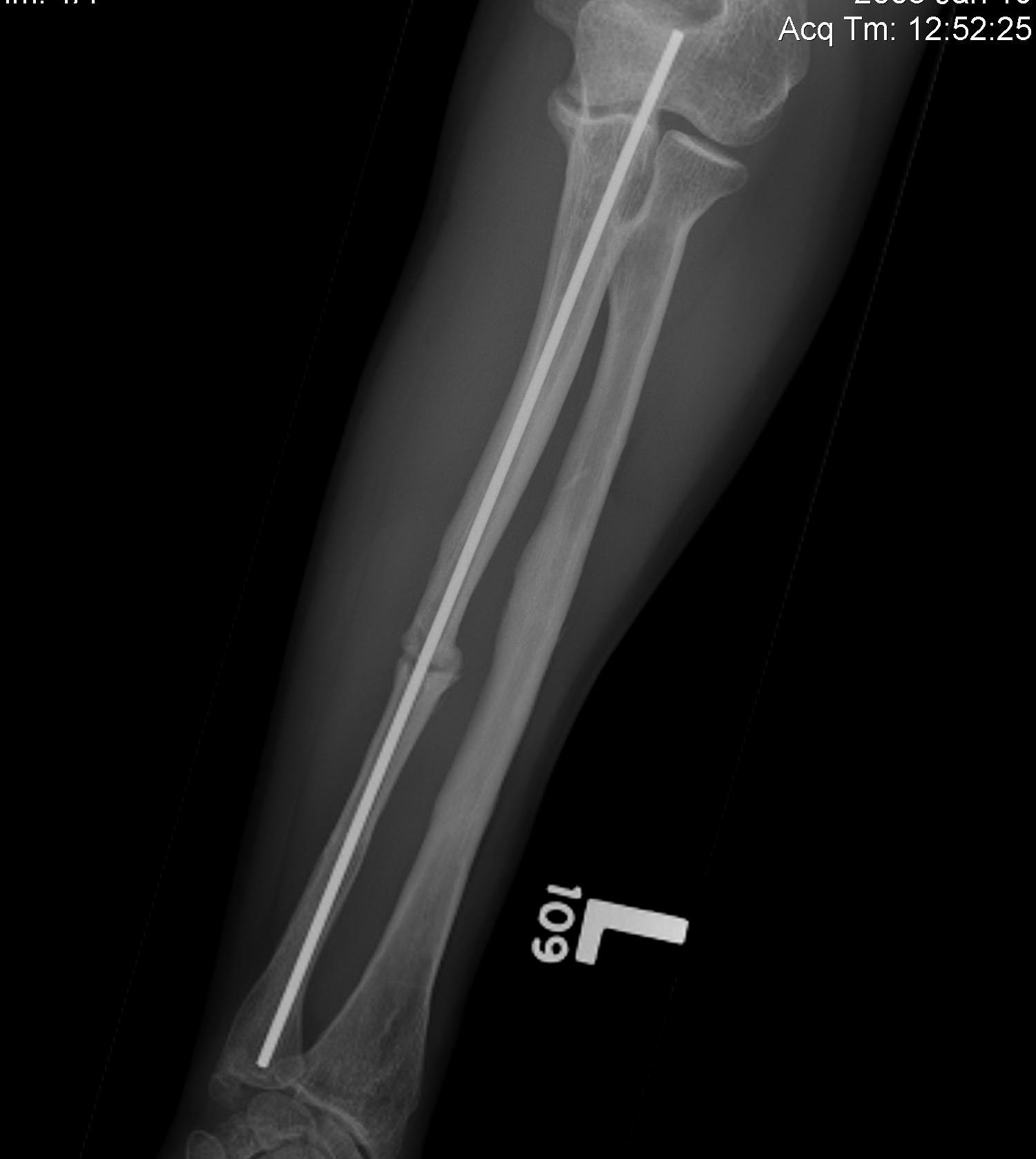 Ulna Intramedullary Wire